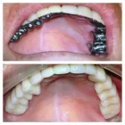 La imagen 8 de la Empresa CLINICA DENTAL ODONTODIGITAL Zirconium Crown en Miraflores LAM