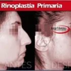 La imagen 4 de la Empresa INSTITUTO DE CIRUGÍA PLÁSTICA JORGE MORENO SAC Rinoplastía en Surco LAM