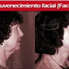 La imagen 10 de la Empresa INSTITUTO DE CIRUGÍA PLÁSTICA JORGE MORENO SAC Rinoplastía en Surco LAM